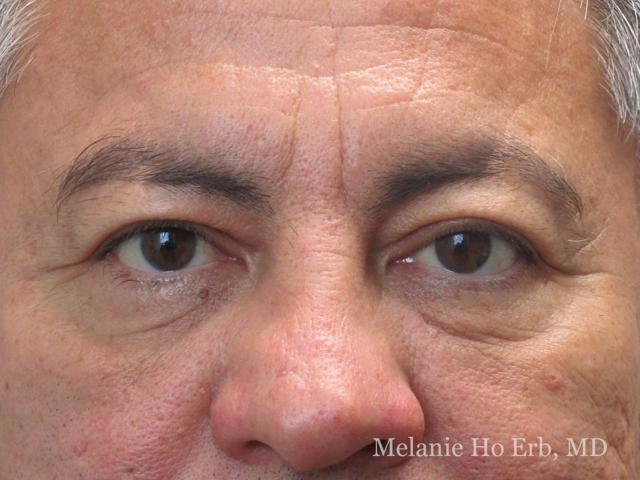 Brow Lift before at Melanie Ho Erb, MD - Laser, Cosmetic, and Oculoplastic Surgery in Irvine, CA