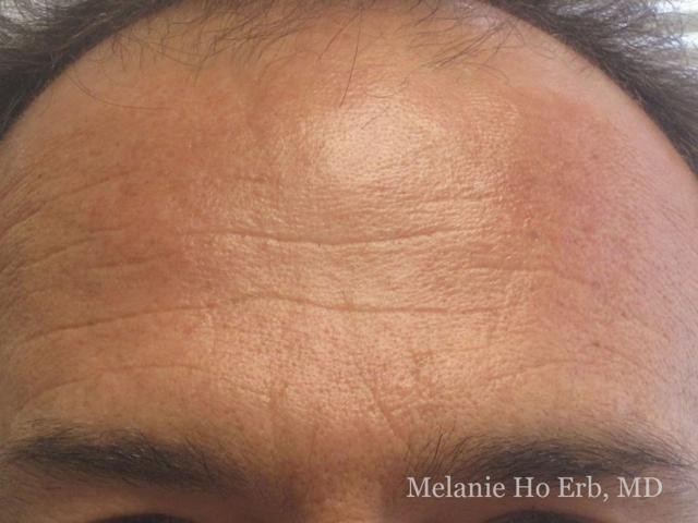 Botox after at Melanie Ho Erb, MD - Laser, Cosmetic, and Oculoplastic Surgery in Irvine, CA
