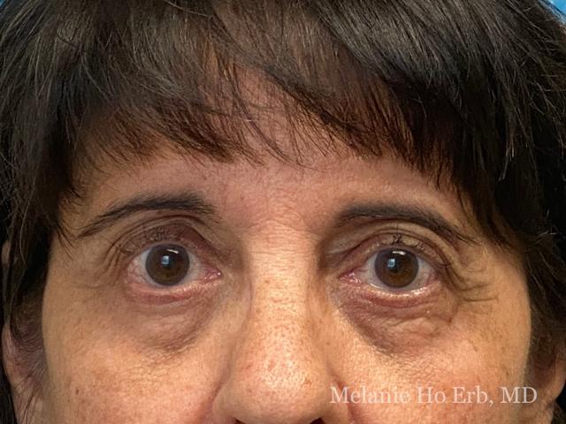 Brow Lift before at Melanie Ho Erb, MD - Laser, Cosmetic, and Oculoplastic Surgery in Irvine, CA