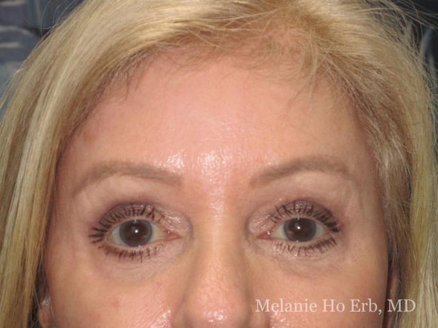 Brow Lift after at Melanie Ho Erb, MD - Laser, Cosmetic, and Oculoplastic Surgery in Irvine, CA