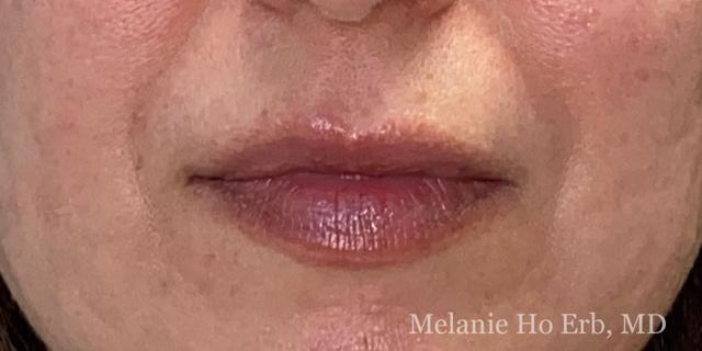 Lip Filler after at Melanie Ho Erb, MD - Laser, Cosmetic, and Oculoplastic Surgery in Irvine, CA