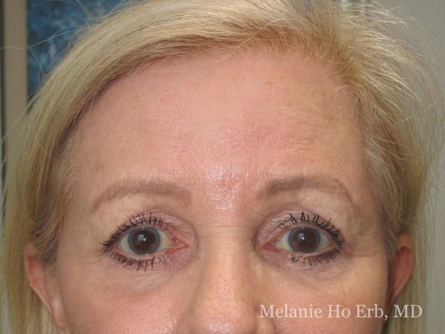 Brow Lift before at Melanie Ho Erb, MD - Laser, Cosmetic, and Oculoplastic Surgery in Irvine, CA