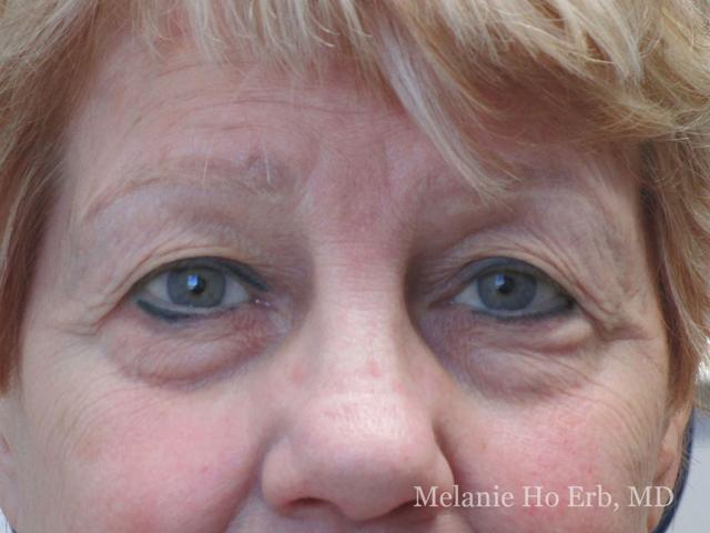 Brow Lift before at Melanie Ho Erb, MD - Laser, Cosmetic, and Oculoplastic Surgery in Irvine, CA