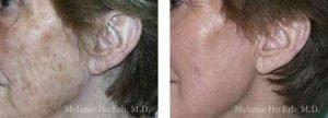 Melanie Ho Erb, MD - Laser, Cosmetic, and Oculoplastic Surgery result — Irvine, CA