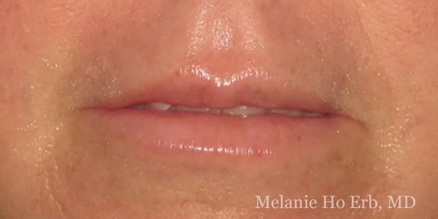 Lip Filler after at Melanie Ho Erb, MD - Laser, Cosmetic, and Oculoplastic Surgery in Irvine, CA