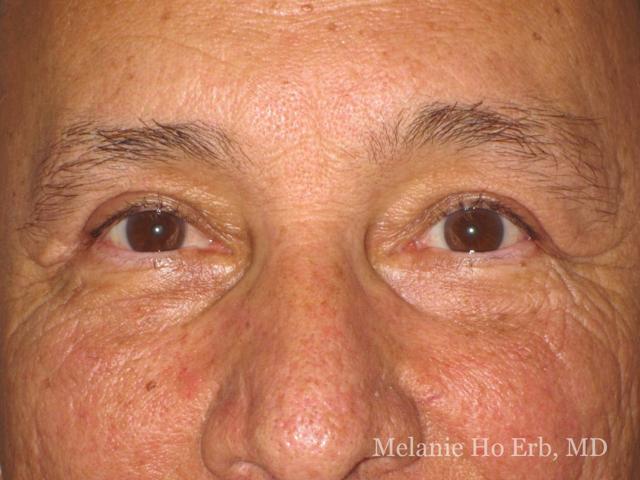 Brow Lift after at Melanie Ho Erb, MD - Laser, Cosmetic, and Oculoplastic Surgery in Irvine, CA