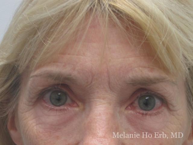 Brow Lift before at Melanie Ho Erb, MD - Laser, Cosmetic, and Oculoplastic Surgery in Irvine, CA