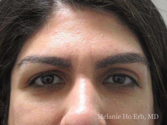 Brow Lift before at Melanie Ho Erb, MD - Laser, Cosmetic, and Oculoplastic Surgery in Irvine, CA