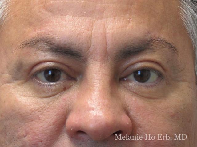 Brow Lift after at Melanie Ho Erb, MD - Laser, Cosmetic, and Oculoplastic Surgery in Irvine, CA