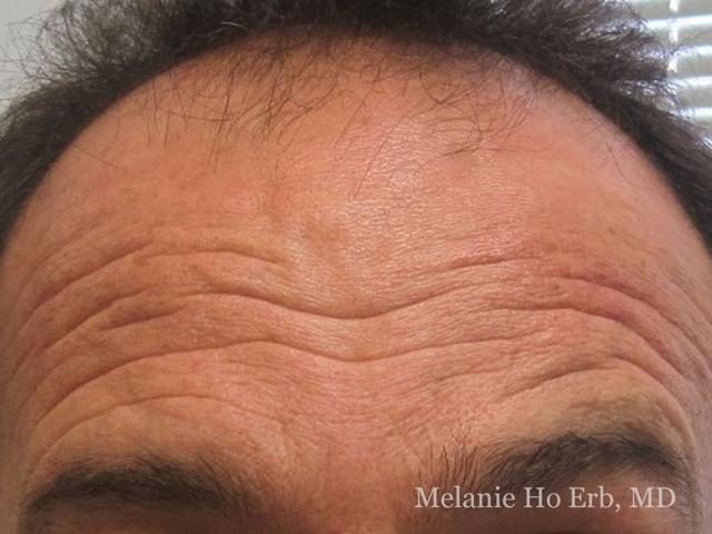 Botox before at Melanie Ho Erb, MD - Laser, Cosmetic, and Oculoplastic Surgery in Irvine, CA