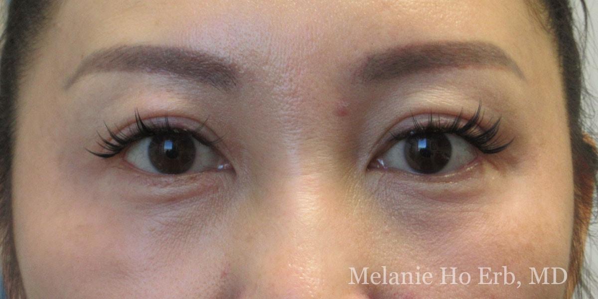Melanie Ho Erb, MD - Laser, Cosmetic, and Oculoplastic Surgery eyelid lift after — Irvine, CA