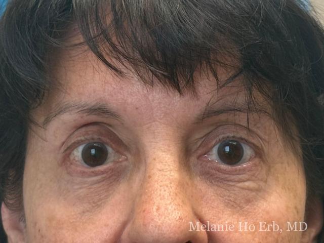 Brow Lift after at Melanie Ho Erb, MD - Laser, Cosmetic, and Oculoplastic Surgery in Irvine, CA
