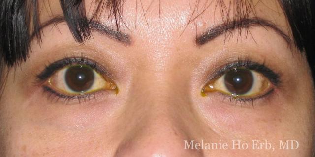 Blepharoplasty before at Melanie Ho Erb, MD - Laser, Cosmetic, and Oculoplastic Surgery in Irvine, CA