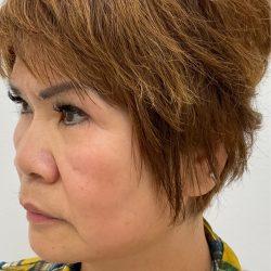 Skinzone Laser & Cosmetic Surgery: Dr. Hannah Vu, MD blepharoplasty after — Alhambra, CA
