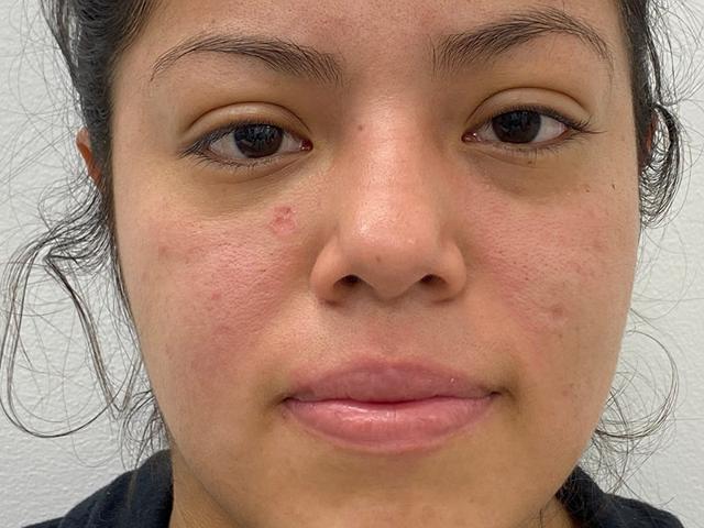 Morpheus8 after at Skinzone Laser & Cosmetic Surgery: Dr. Hannah Vu, MD in Alhambra, CA