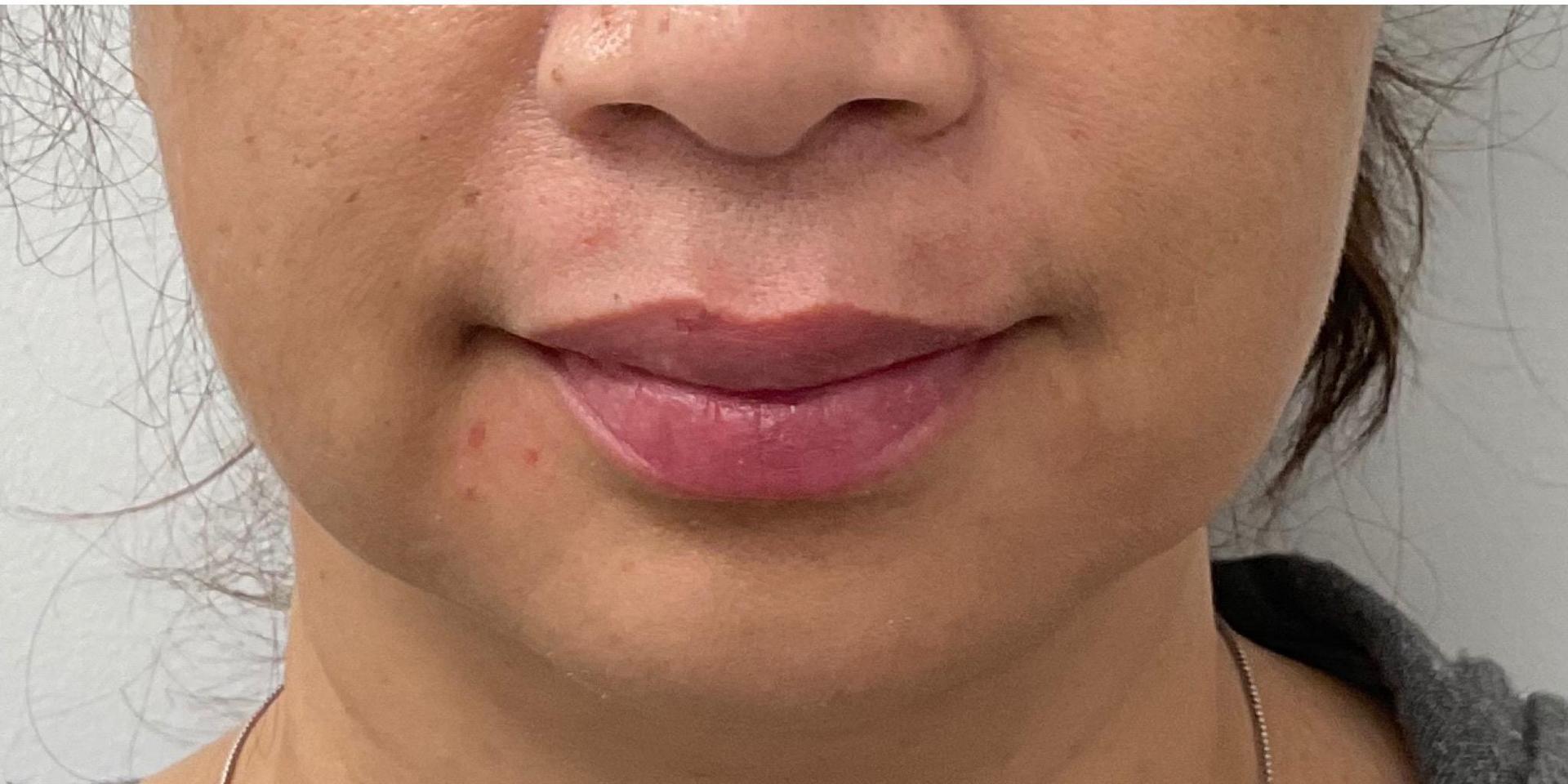 Skinzone Laser & Cosmetic Surgery: Dr. Hannah Vu, MD lip filler after — Alhambra, CA