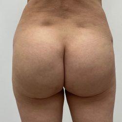 Skinzone Laser & Cosmetic Surgery: Dr. Hannah Vu, MD bbl after — Alhambra, CA