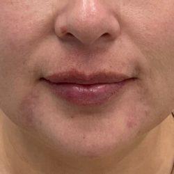 Skinzone Laser & Cosmetic Surgery: Dr. Hannah Vu, MD lip filler after — Alhambra, CA