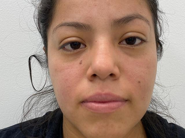 Morpheus8 before at Skinzone Laser & Cosmetic Surgery: Dr. Hannah Vu, MD in Alhambra, CA