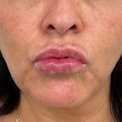 Skinzone Laser & Cosmetic Surgery: Dr. Hannah Vu, MD lip filler after — Alhambra, CA