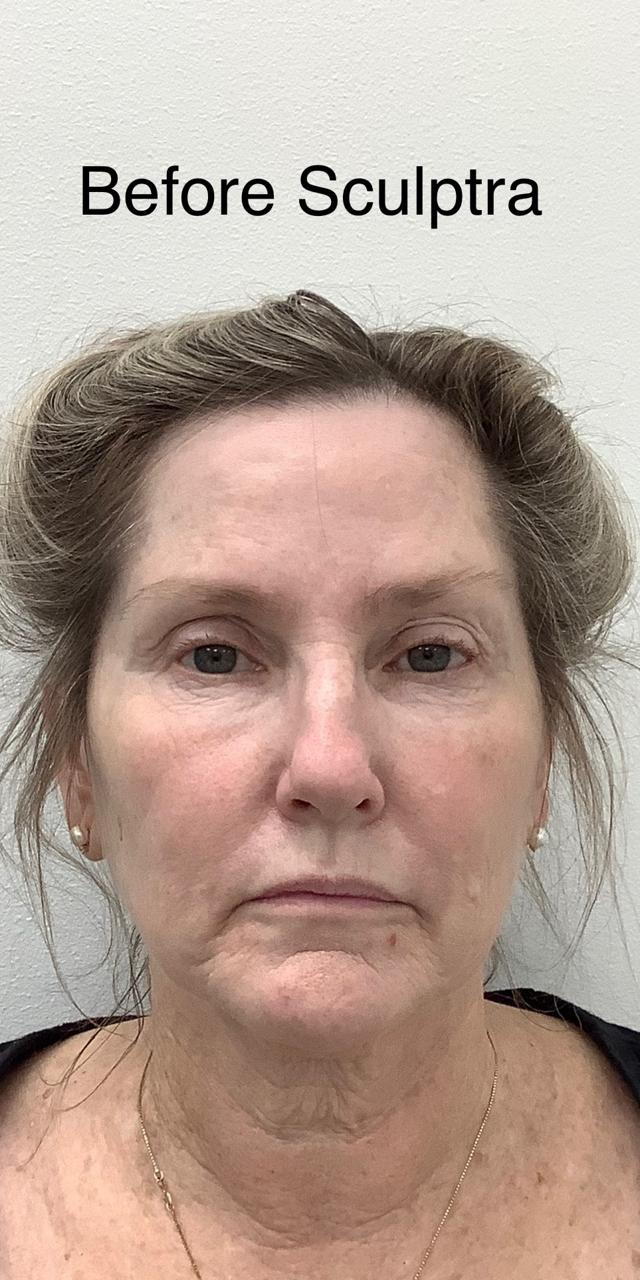 Juvederm before at Skinzone Laser & Cosmetic Surgery: Dr. Hannah Vu, MD in Alhambra, CA