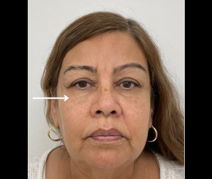Skinzone Laser & Cosmetic Surgery: Dr. Hannah Vu, MD after — Alhambra, CA
