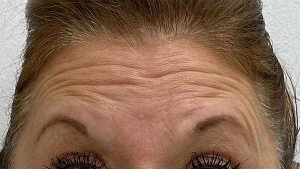 Botox before at Skinzone Laser & Cosmetic Surgery: Dr. Hannah Vu, MD in Alhambra, CA