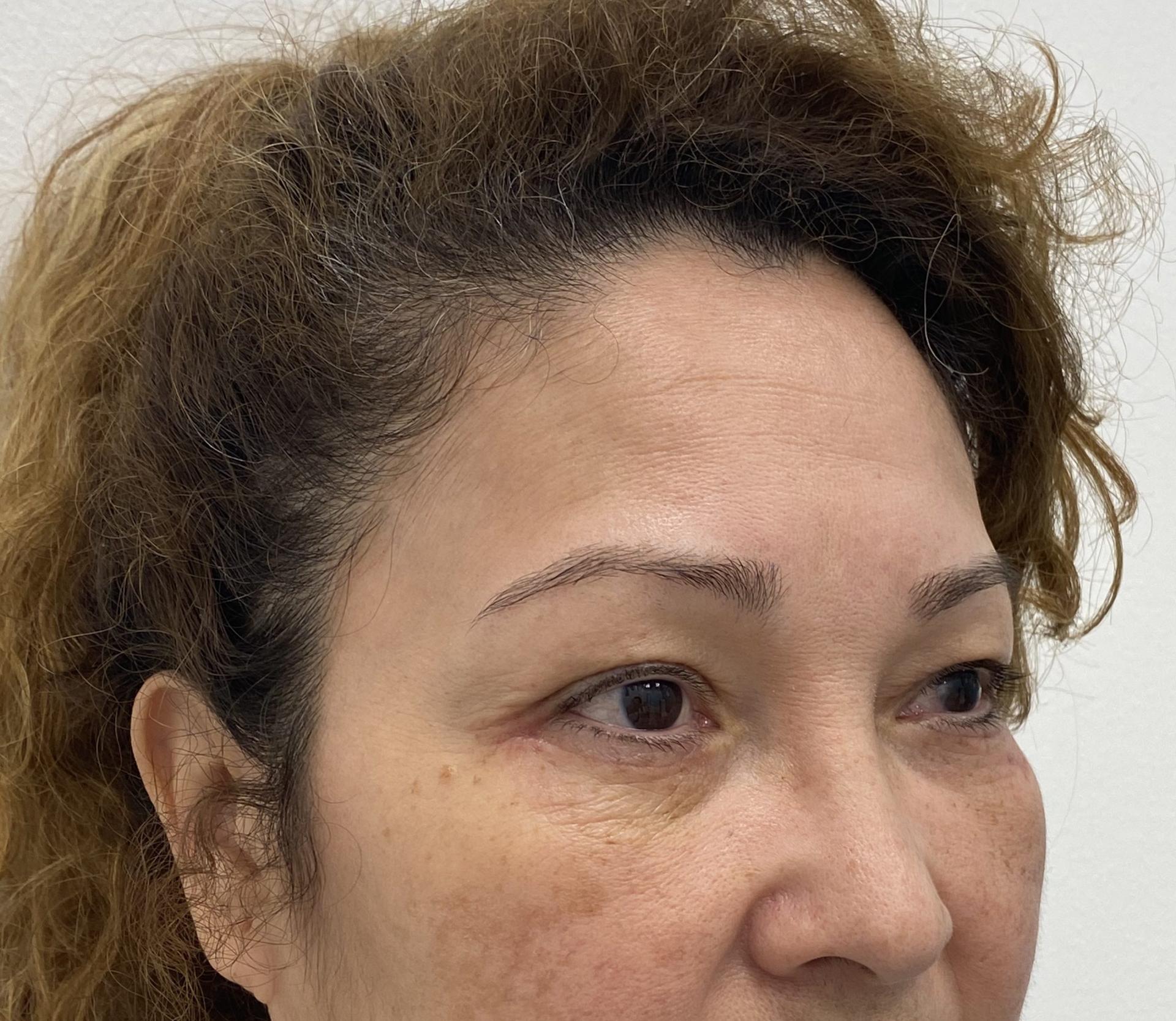 Skinzone Laser & Cosmetic Surgery: Dr. Hannah Vu, MD after — Alhambra, CA