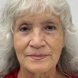 Skinzone Laser & Cosmetic Surgery: Dr. Hannah Vu, MD after — Alhambra, CA