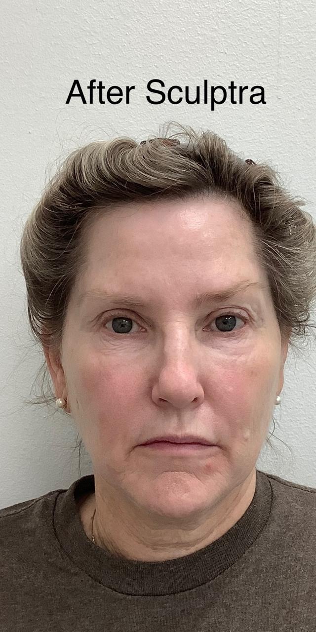 Juvederm after at Skinzone Laser & Cosmetic Surgery: Dr. Hannah Vu, MD in Alhambra, CA