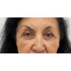 Skinzone Laser & Cosmetic Surgery: Dr. Hannah Vu, MD after — Alhambra, CA