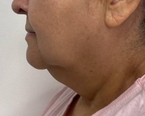 Liposuction before at Skinzone Laser & Cosmetic Surgery: Dr. Hannah Vu, MD in Alhambra, CA