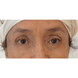 Skinzone Laser & Cosmetic Surgery: Dr. Hannah Vu, MD blepharoplasty after — Alhambra, CA