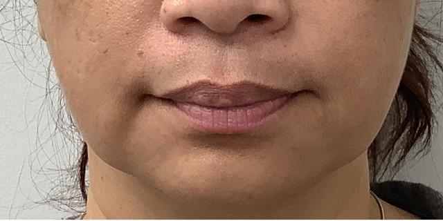 Lip Filler before at Skinzone Laser & Cosmetic Surgery: Dr. Hannah Vu, MD in Alhambra, CA