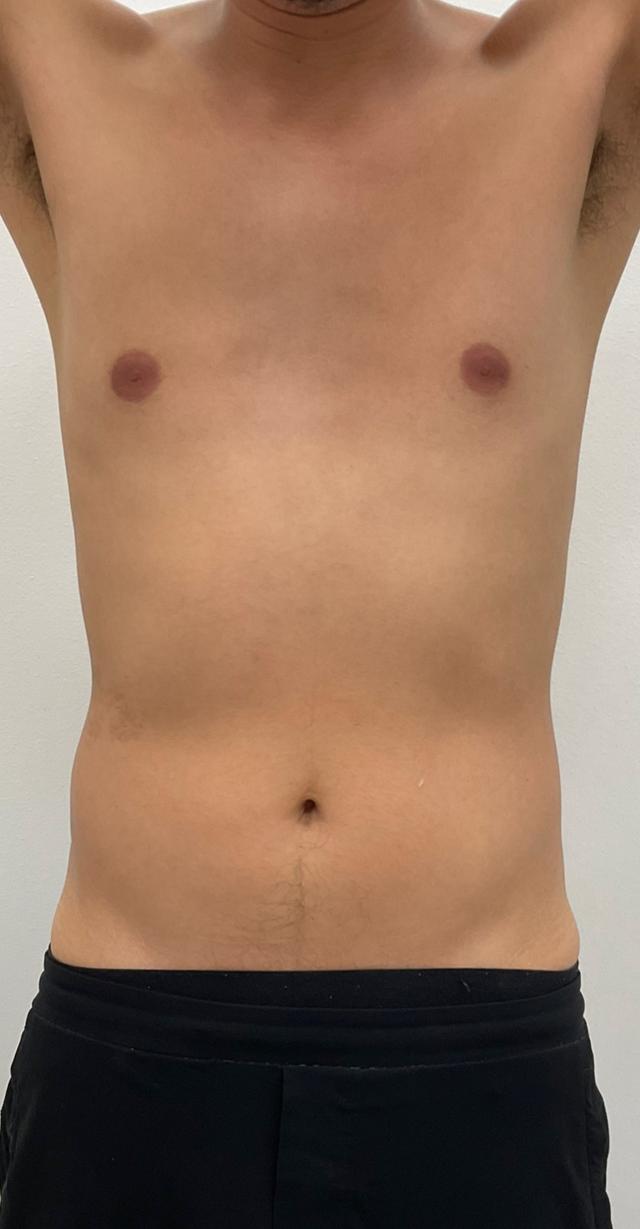 CoolSculpting after at Skinzone Laser & Cosmetic Surgery: Dr. Hannah Vu, MD in Alhambra, CA