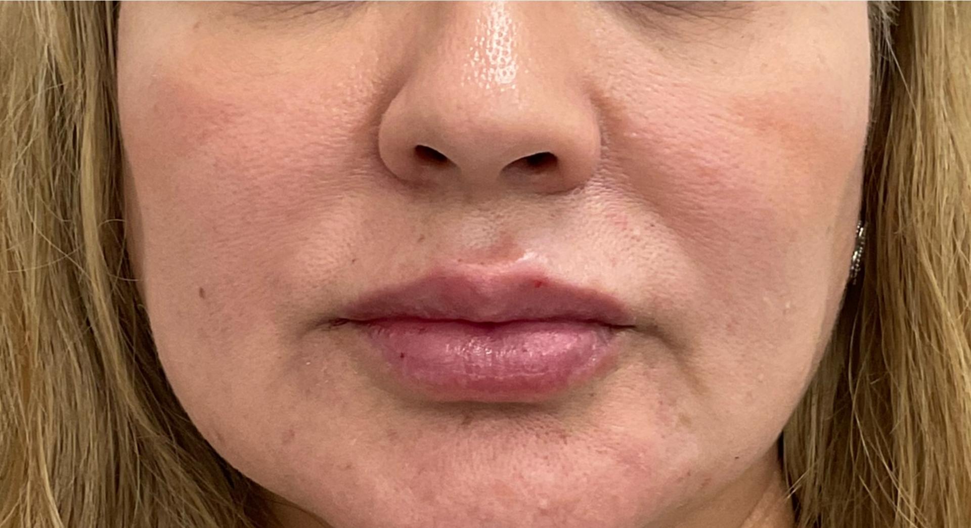 Skinzone Laser & Cosmetic Surgery: Dr. Hannah Vu, MD lip filler after — Alhambra, CA