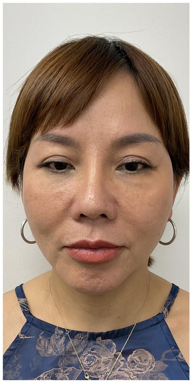 Jawline Filler before at Skinzone Laser & Cosmetic Surgery: Dr. Hannah Vu, MD in Alhambra, CA