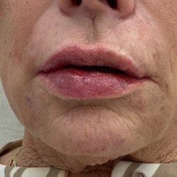 Skinzone Laser & Cosmetic Surgery: Dr. Hannah Vu, MD lip filler after — Alhambra, CA