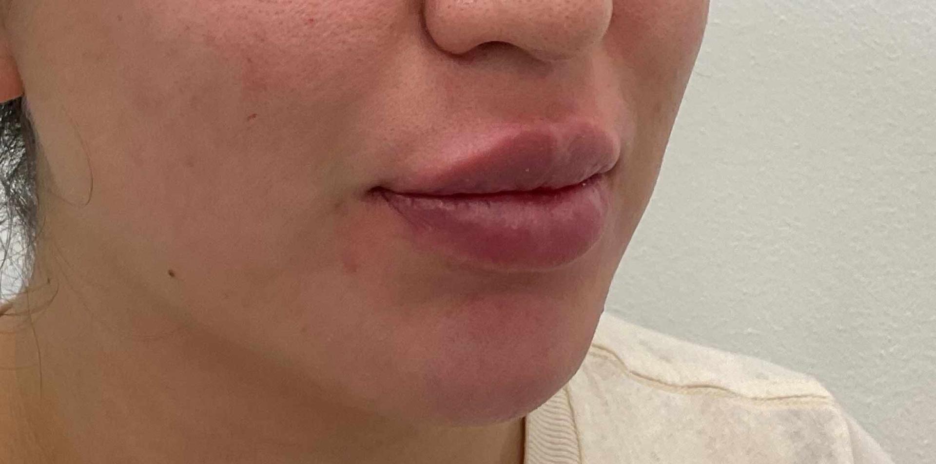 Skinzone Laser & Cosmetic Surgery: Dr. Hannah Vu, MD lip filler after — Alhambra, CA