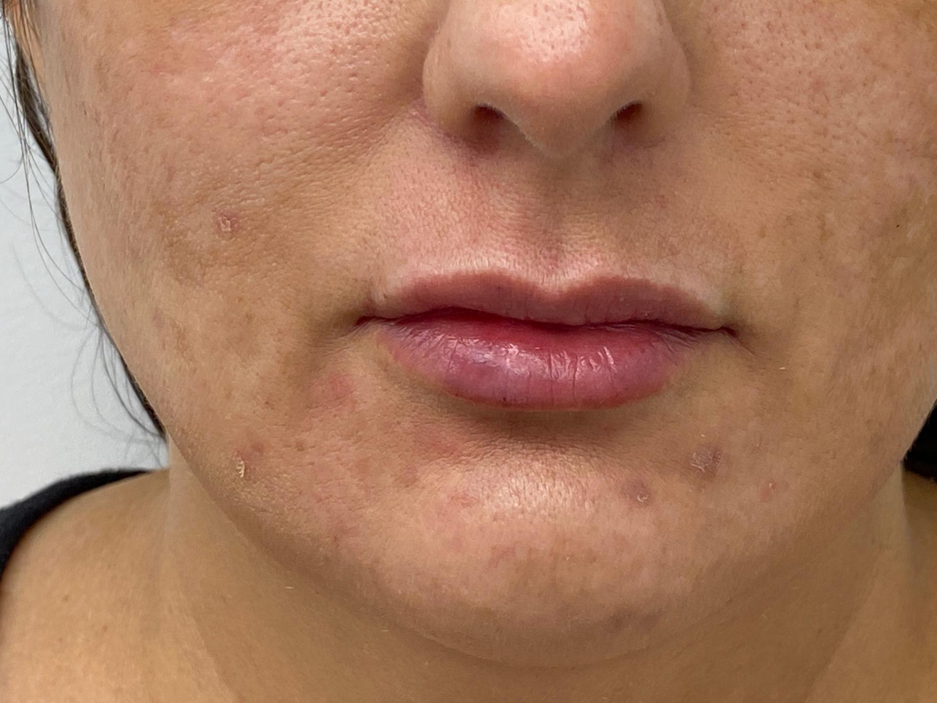Skinzone Laser & Cosmetic Surgery: Dr. Hannah Vu, MD lip filler after — Alhambra, CA