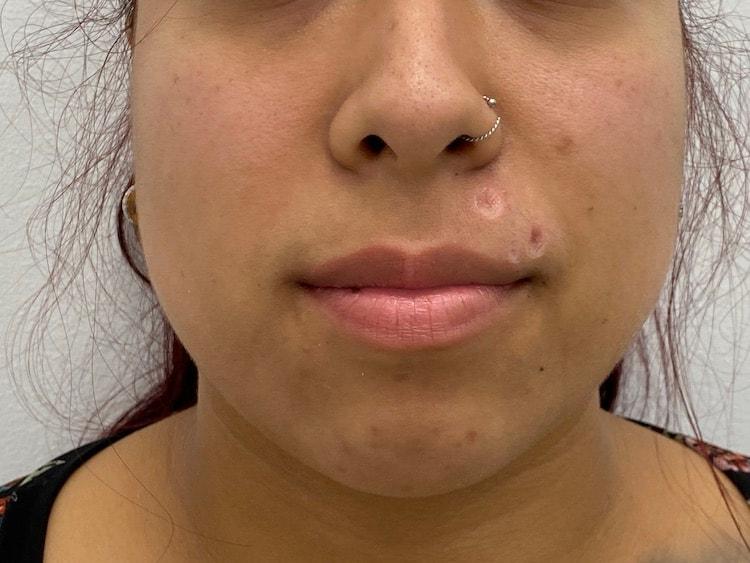 Skinzone Laser & Cosmetic Surgery: Dr. Hannah Vu, MD laser treatment after — Alhambra, CA