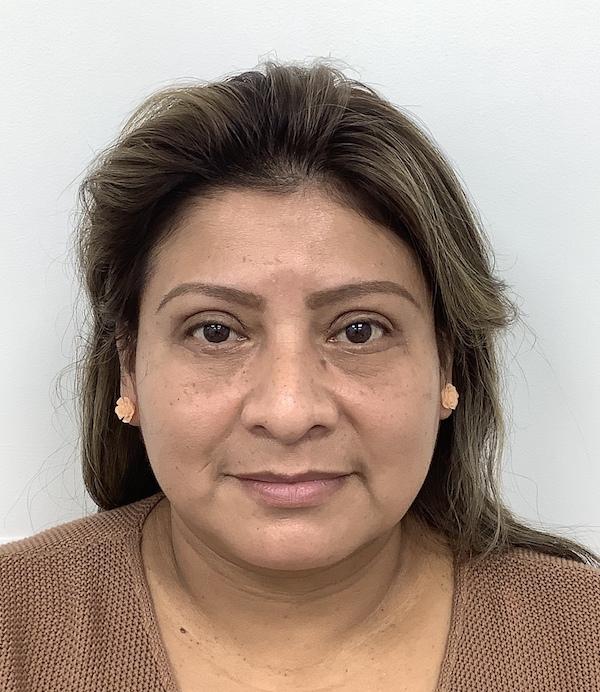 Skinzone Laser & Cosmetic Surgery: Dr. Hannah Vu, MD after — Alhambra, CA
