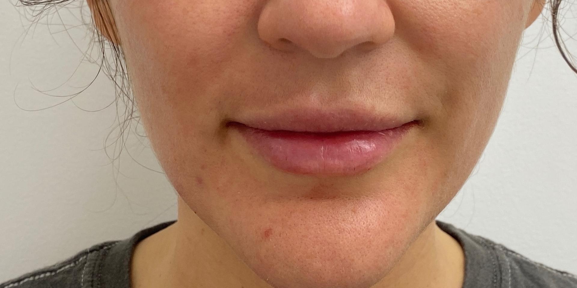 Skinzone Laser & Cosmetic Surgery: Dr. Hannah Vu, MD lip filler after — Alhambra, CA