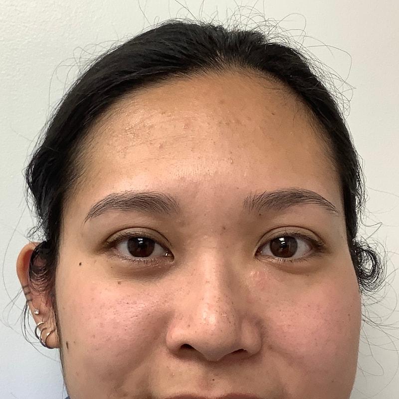 Skinzone Laser & Cosmetic Surgery: Dr. Hannah Vu, MD laser treatment after — Alhambra, CA