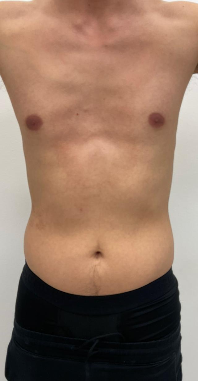 CoolSculpting before at Skinzone Laser & Cosmetic Surgery: Dr. Hannah Vu, MD in Alhambra, CA