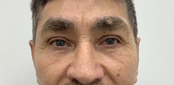 Skinzone Laser & Cosmetic Surgery: Dr. Hannah Vu, MD after — Alhambra, CA