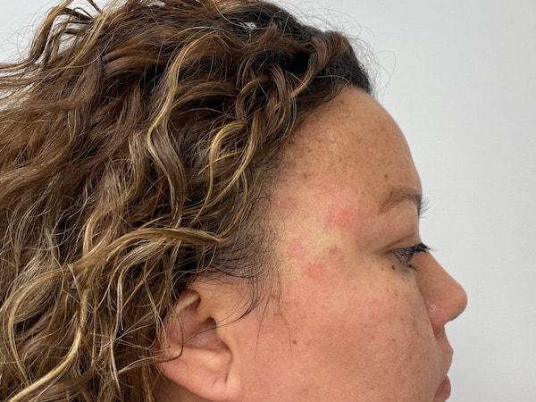 Skinzone Laser & Cosmetic Surgery: Dr. Hannah Vu, MD laser treatment after — Alhambra, CA