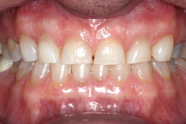 Pearls of Dentistry smile makeover after — San Diego, CA