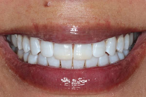 Pearls of Dentistry smile makeover after — San Diego, CA