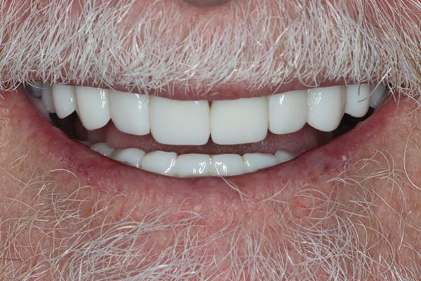 Pearls of Dentistry smile makeover after — San Diego, CA